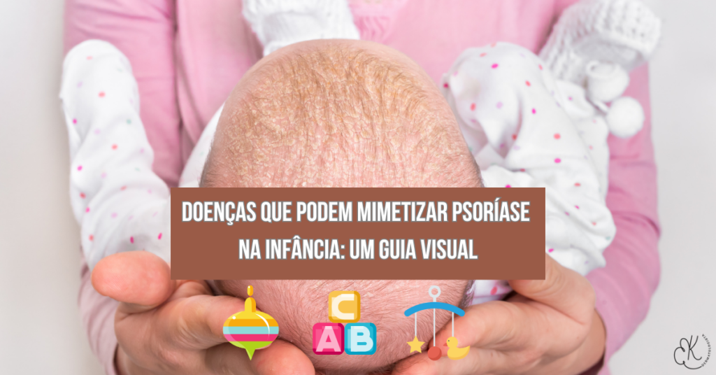 Doenças que imitam Psoríase na Infância: Um Guia Visual