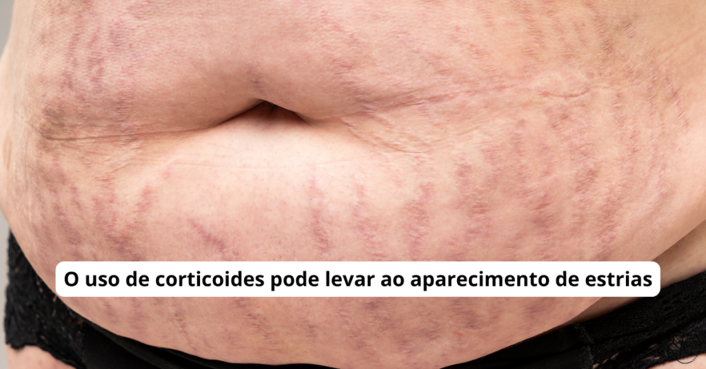 Estrias na pele causadas pelo uso de corticoides