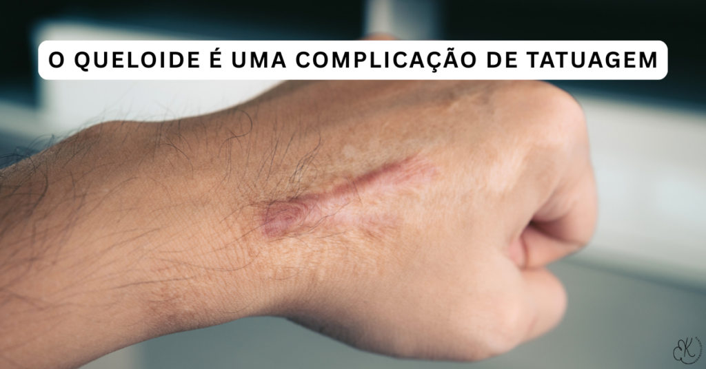 Queloide saliente em dorso de mão masculina