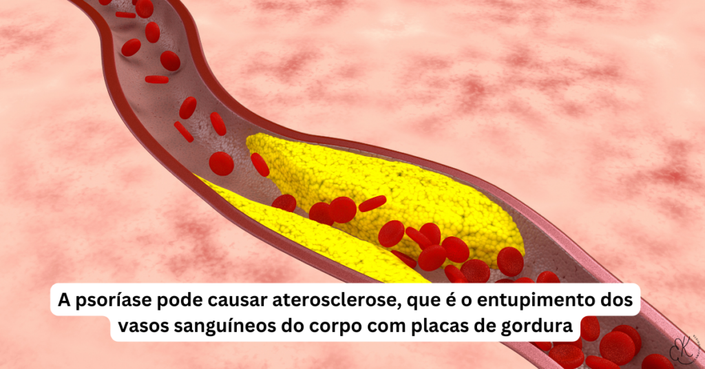 Representação de vaso sanguíneo entupido por placas de gordura