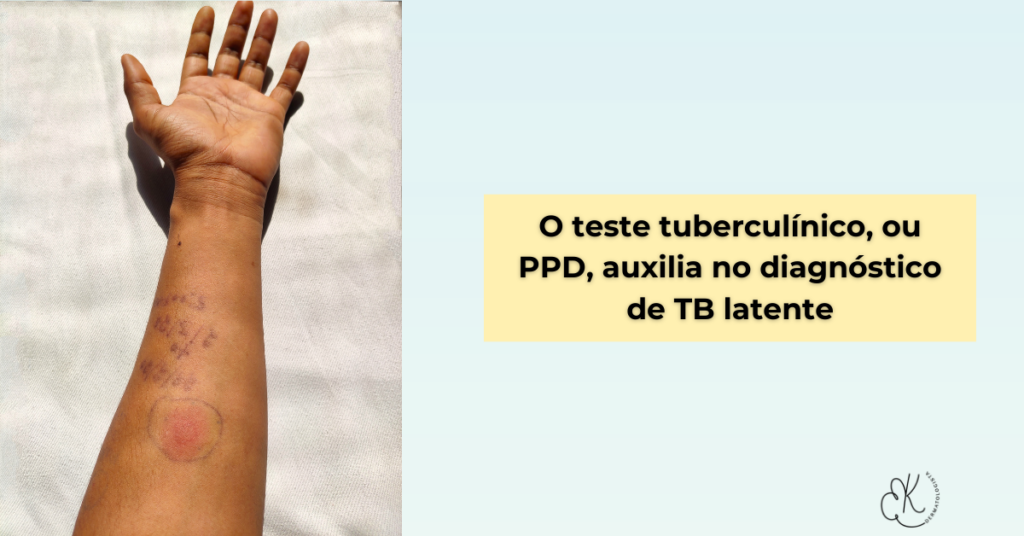 Braço com reação positiva ao teste tuberculínico (PPD)