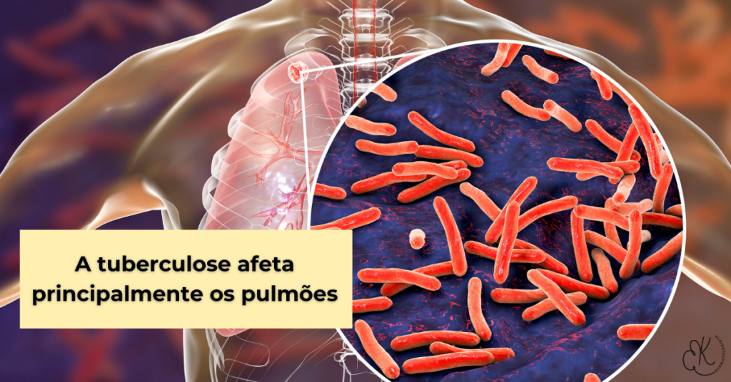 Ilustração de pulmões com foco em bactérias da tuberculose